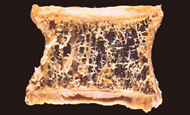 骨密度が低く内部がスカスカ状態の骨